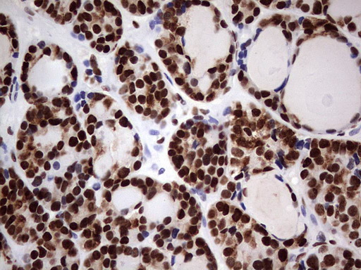N4BP2L2 Antibody - Immunohistochemical staining of paraffin-embedded Carcinoma of Human thyroid tissue using anti-N4BP2L2 mouse monoclonal antibody. (Heat-induced epitope retrieval by 1 mM EDTA in 10mM Tris, pH8.5, 120C for 3min,