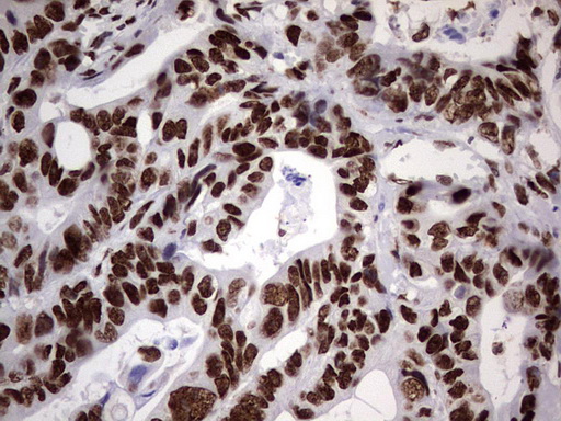 N4BP2L2 Antibody - Immunohistochemical staining of paraffin-embedded Adenocarcinoma of Human colon tissue using anti-N4BP2L2 mouse monoclonal antibody. (Heat-induced epitope retrieval by 1 mM EDTA in 10mM Tris, pH8.5, 120C for 3min,