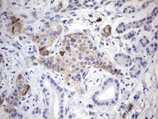 N4BP2L2 Antibody - Immunohistochemical staining of paraffin-embedded Carcinoma of Human pancreas tissue using anti-N4BP2L2 mouse monoclonal antibody. (Heat-induced epitope retrieval by 1 mM EDTA in 10mM Tris, pH8.5, 120C for 3min,