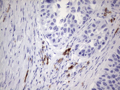 N4BP2L2 Antibody - Immunohistochemical staining of paraffin-embedded Carcinoma of Human kidney tissue using anti-N4BP2L2 mouse monoclonal antibody. (Heat-induced epitope retrieval by 1 mM EDTA in 10mM Tris, pH8.5, 120C for 3min,