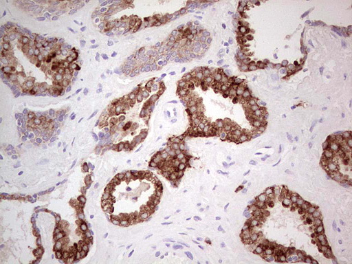 N4BP2L2 Antibody - Immunohistochemical staining of paraffin-embedded Carcinoma of Human prostate tissue using anti-N4BP2L2 mouse monoclonal antibody. (Heat-induced epitope retrieval by 1 mM EDTA in 10mM Tris, pH8.5, 120C for 3min,