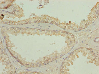 N4BP2L2 Antibody - Immunohistochemistry of paraffin-embedded human prostate cancer using N4BP2L2 Antibody at dilution of 1:100