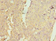 NAA10 / ARD1A Antibody - Immunohistochemistry of paraffin-embedded human rectal cancer using antibody at 1:100 dilution.