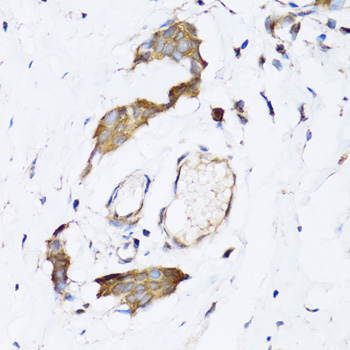 NAA10 / ARD1A Antibody - Immunohistochemistry of paraffin-embedded human breast cancer tissue.