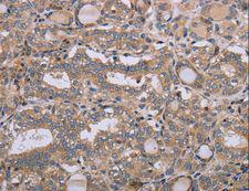 NAA25 Antibody - Immunohistochemistry of paraffin-embedded Human thyroid cancer using NAA25 Polyclonal Antibody at dilution of 1:40.
