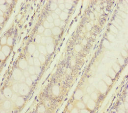 NAA25 Antibody - Immunohistochemistry of paraffin-embedded human colon cancer at dilution of 1:100
