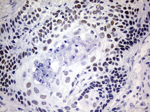 NAB1 Antibody - IHC of paraffin-embedded Carcinoma of Human lung tissue using anti-NAB1 mouse monoclonal antibody. (Heat-induced epitope retrieval by 1 mM EDTA in 10mM Tris, pH9.0, 120°C for 3min).