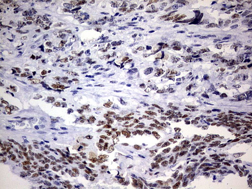 NAB1 Antibody - IHC of paraffin-embedded Adenocarcinoma of Human endometrium tissue using anti-NAB1 mouse monoclonal antibody. (Heat-induced epitope retrieval by 1 mM EDTA in 10mM Tris, pH9.0, 120°C for 3min).