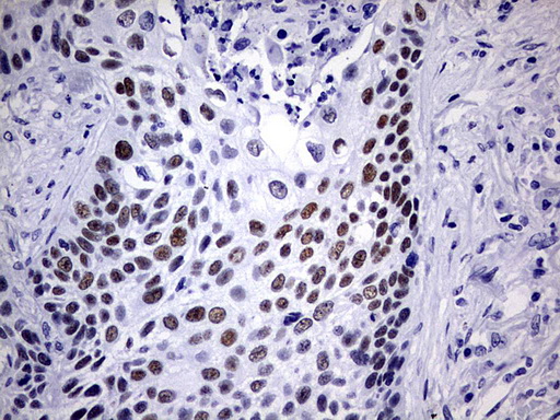 NAB1 Antibody - IHC of paraffin-embedded Carcinoma of Human lung tissue using anti-NAB1 mouse monoclonal antibody. (Heat-induced epitope retrieval by 1 mM EDTA in 10mM Tris, pH9.0, 120°C for 3min).