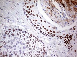 NAB1 Antibody - IHC of paraffin-embedded Carcinoma of Human lung tissue using anti-NAB1 mouse monoclonal antibody. (Heat-induced epitope retrieval by 10mM citric buffer, pH6.0, 120°C for 3min).