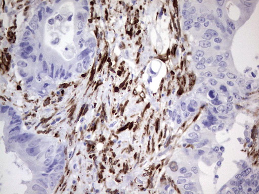 NAB2 Antibody - IHC of paraffin-embedded Adenocarcinoma of Human colon tissue using anti-NAB2 mouse monoclonal antibody. (Heat-induced epitope retrieval by 1 mM EDTA in 10mM Tris, pH8.5, 120°C for 3min).