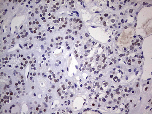 NAB2 Antibody - IHC of paraffin-embedded Carcinoma of Human thyroid tissue using anti-NAB2 mouse monoclonal antibody. (Heat-induced epitope retrieval by 1 mM EDTA in 10mM Tris, pH8.5, 120°C for 3min).