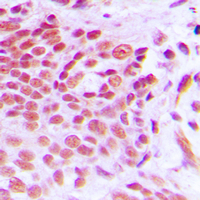 NAB2 Antibody - Immunohistochemical analysis of NAB2 staining in human breast cancer formalin fixed paraffin embedded tissue section. The section was pre-treated using heat mediated antigen retrieval with sodium citrate buffer (pH 6.0). The section was then incubated with the antibody at room temperature and detected using an HRP conjugated compact polymer system. DAB was used as the chromogen. The section was then counterstained with hematoxylin and mounted with DPX.