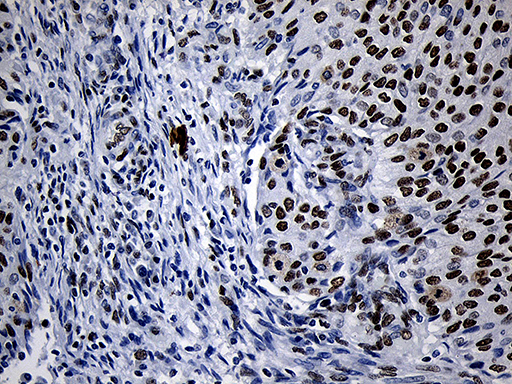 NABP1 / OBFC2A Antibody - Immunohistochemical staining of paraffin-embedded Carcinoma of Human bladder tissue using anti-NABP1 mouse monoclonal antibody. (Heat-induced epitope retrieval by 1mM EDTA in 10mM Tris buffer. (pH8.5) at 120°C for 3 min. (1:500)