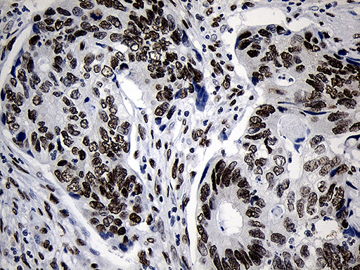NABP1 / OBFC2A Antibody - Immunohistochemical staining of paraffin-embedded Adenocarcinoma of Human colon tissue using anti-NABP1 mouse monoclonal antibody. (Heat-induced epitope retrieval by 1mM EDTA in 10mM Tris buffer. (pH8.5) at 120°C for 3 min. (1:500)