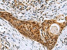 NABP1 / OBFC2A Antibody - Immunohistochemistry of paraffin-embedded Human esophagus cancer tissue  using NABP1 Polyclonal Antibody at dilution of 1:80(×200)