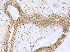 NABP1 / OBFC2A Antibody - Immunohistochemistry of paraffin-embedded Human breast cancer tissue  using NABP1 Polyclonal Antibody at dilution of 1:50(×200)
