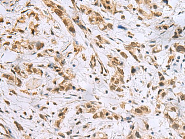 NABP1 / OBFC2A Antibody - Immunohistochemistry of paraffin-embedded Human gastric cancer tissue  using NABP1 Polyclonal Antibody at dilution of 1:50(×200)