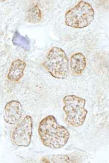 NABP2 Antibody - Detection of Human SSB1 by Immunohistochemistry. Sample: FFPE section of human colon carcinoma. Antibody: Affinity purified rabbit anti-SSB1 used at a dilution of 1:500.