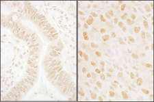 NABP2 Antibody - Detection of Human and Mouse SSB1 by Immunohistochemistry. Sample: FFPE sections of human colon carcinoma (left) and mouse squamous cell carcinoma (right). Antibody: Affinity purified rabbit anti-SSB1 used at a dilution of 1:1000 (1 ug/ml). Detection: DAB.