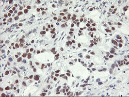 NABP2 Antibody - IHC of paraffin-embedded Carcinoma of Human lung tissue using anti-OBFC2B mouse monoclonal antibody.