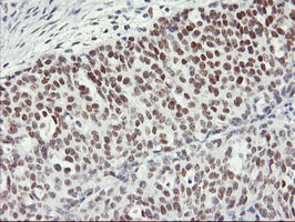 NABP2 Antibody - IHC of paraffin-embedded Adenocarcinoma of Human ovary tissue using anti-OBFC2B mouse monoclonal antibody.