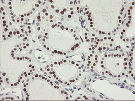 NABP2 Antibody - IHC of paraffin-embedded Carcinoma of Human thyroid tissue using anti-OBFC2B mouse monoclonal antibody.