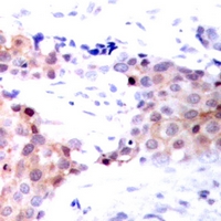 NACA Antibody - Immunohistochemical analysis of NACA1 (pS43) staining in human breast cancer formalin fixed paraffin embedded tissue section. The section was pre-treated using heat mediated antigen retrieval with sodium citrate buffer (pH 6.0). The section was then incubated with the antibody at room temperature and detected using an HRP conjugated compact polymer system. DAB was used as the chromogen. The section was then counterstained with haematoxylin and mounted with DPX.