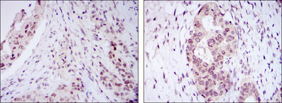 NACC1 / NAC1 Antibody - IHC of paraffin-embedded mammary cancer tissues (left) and ovarian cancer tissues (right) using NACC1 mouse monoclonal antibody with DAB staining.
