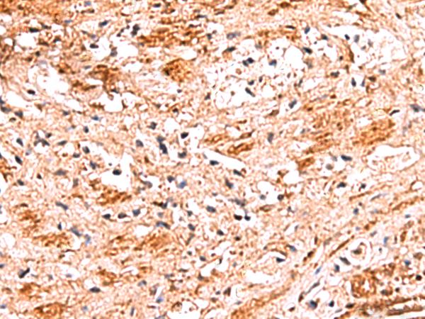 NADK / NAD Kinase Antibody - Immunohistochemistry of paraffin-embedded Human liver cancer tissue  using NADK Polyclonal Antibody at dilution of 1:70(×200)