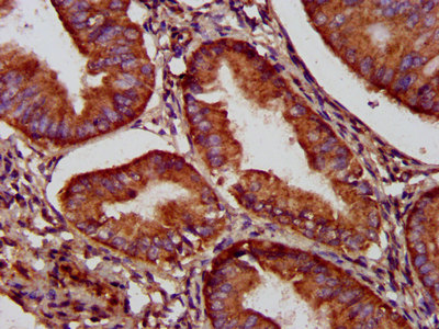 NADK2 / C5orf33 Antibody - Immunohistochemistry image at a dilution of 1:500 and staining in paraffin-embedded human endometrial cancer performed on a Leica BondTM system. After dewaxing and hydration, antigen retrieval was mediated by high pressure in a citrate buffer (pH 6.0) . Section was blocked with 10% normal goat serum 30min at RT. Then primary antibody (1% BSA) was incubated at 4 °C overnight. The primary is detected by a biotinylated secondary antibody and visualized using an HRP conjugated SP system.