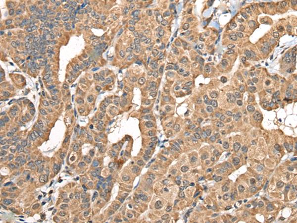 NADK2 / C5orf33 Antibody - Immunohistochemistry of paraffin-embedded Human thyroid cancer tissue  using NADK2 Polyclonal Antibody at dilution of 1:40(×200)