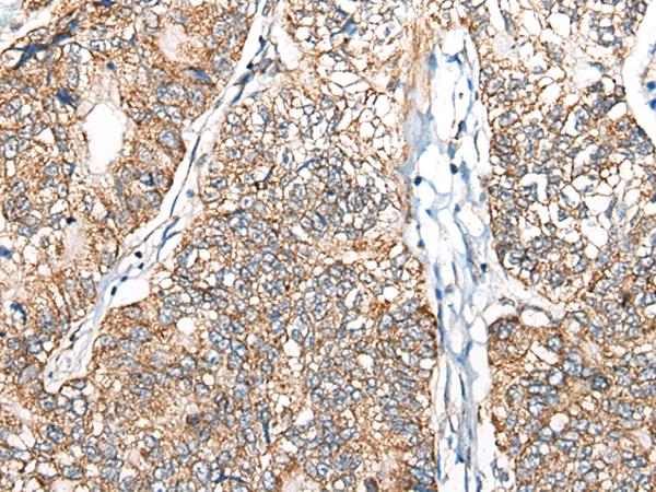NADK2 / C5orf33 Antibody - Immunohistochemistry of paraffin-embedded Human gastric cancer tissue  using NADK2 Polyclonal Antibody at dilution of 1:40(×200)