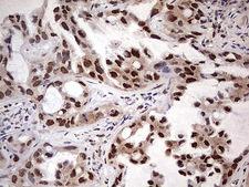 NAE1 / APPBP1 Antibody - Immunohistochemical staining of paraffin-embedded Carcinoma of Human lung tissue using anti-NAE1 mouse monoclonal antibody. (Heat-induced epitope retrieval by 1 mM EDTA in 10mM Tris, pH8.5, 120C for 3min,