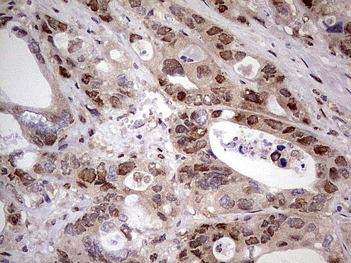 NAE1 / APPBP1 Antibody - Immunohistochemical staining of paraffin-embedded Adenocarcinoma of Human colon tissue using anti-NAE1 mouse monoclonal antibody. (Heat-induced epitope retrieval by 1 mM EDTA in 10mM Tris, pH8.5, 120C for 3min,