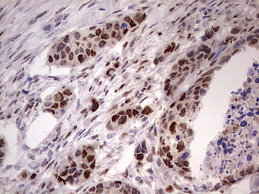 NAE1 / APPBP1 Antibody - Immunohistochemical staining of paraffin-embedded Carcinoma of Human kidney tissue using anti-NAE1 mouse monoclonal antibody. (Heat-induced epitope retrieval by 1 mM EDTA in 10mM Tris, pH8.5, 120C for 3min,