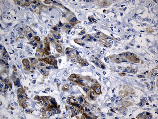 NAF-1 / CISD2 Antibody - Immunohistochemical staining of paraffin-embedded Carcinoma of Human pancreas tissue using anti-CISD2 mouse monoclonal antibody. (Heat-induced epitope retrieval by 1mM EDTA in 10mM Tris buffer. (pH8.5) at 120°C for 3 min. (1:500)