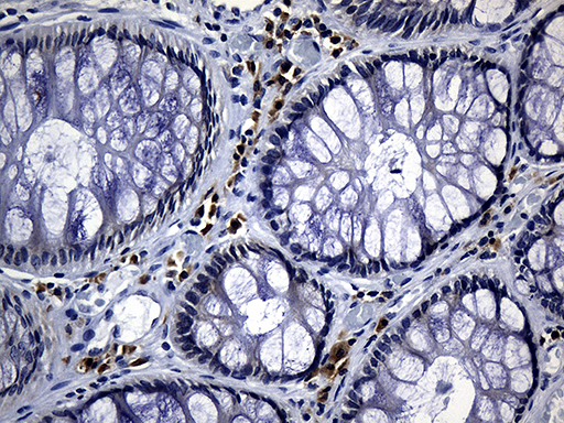 NAF-1 / CISD2 Antibody - Immunohistochemical staining of paraffin-embedded Adenocarcinoma of Human colon tissue using anti-CISD2 mouse monoclonal antibody. (Heat-induced epitope retrieval by 1mM EDTA in 10mM Tris buffer. (pH8.5) at 120°C for 3 min. (1:500)