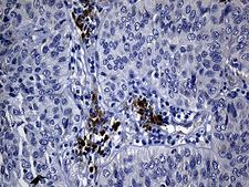 NAF-1 / CISD2 Antibody - Immunohistochemical staining of paraffin-embedded Carcinoma of Human lung tissue using anti-CISD2 mouse monoclonal antibody. (Heat-induced epitope retrieval by 1mM EDTA in 10mM Tris buffer. (pH8.5) at 120°C for 3 min. (1:500)