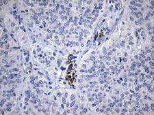 NAF-1 / CISD2 Antibody - Immunohistochemical staining of paraffin-embedded Carcinoma of Human lung tissue using anti-CISD2 mouse monoclonal antibody. (Heat-induced epitope retrieval by 1mM EDTA in 10mM Tris buffer. (pH8.5) at 120°C for 3 min. (1:150)