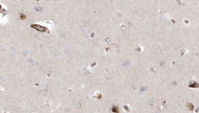 NAF-1 / CISD2 Antibody - 1:100 staining human brain carcinoma tissue by IHC-P. The sample was formaldehyde fixed and a heat mediated antigen retrieval step in citrate buffer was performed. The sample was then blocked and incubated with the antibody for 1.5 hours at 22°C. An HRP conjugated goat anti-rabbit antibody was used as the secondary.