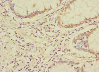 NAG20 / UBAP1 Antibody - Immunohistochemistry of paraffin-embedded human colon cancer using UBAP1 Antibody at dilution of 1:100