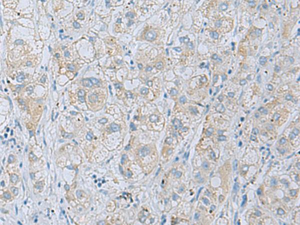 NAGK Antibody - Immunohistochemistry of paraffin-embedded Human liver cancer tissue  using NAGK Polyclonal Antibody at dilution of 1:35(×200)