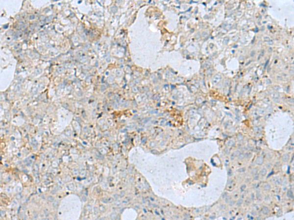 NAGK Antibody - Immunohistochemistry of paraffin-embedded Human ovarian cancer tissue  using NAGK Polyclonal Antibody at dilution of 1:35(×200)