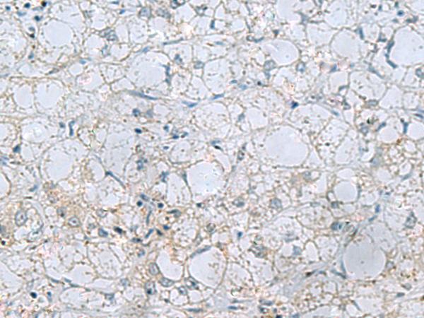 NAGK Antibody - Immunohistochemistry of paraffin-embedded Human liver cancer tissue  using NAGK Polyclonal Antibody at dilution of 1:45(×200)