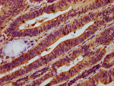 NAGPA Antibody - Immunohistochemistry Dilution at 1:500 and staining in paraffin-embedded human colon cancer performed on a Leica BondTM system. After dewaxing and hydration, antigen retrieval was mediated by high pressure in a citrate buffer (pH 6.0). Section was blocked with 10% normal Goat serum 30min at RT. Then primary antibody (1% BSA) was incubated at 4°C overnight. The primary is detected by a biotinylated Secondary antibody and visualized using an HRP conjugated SP system.