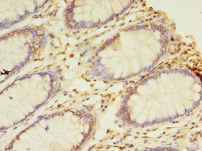 NAIF1 Antibody - Immunohistochemistry of paraffin-embedded human colon cancer using antibody at dilution of 1:100.