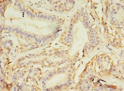 NAIF1 Antibody - Immunohistochemistry of paraffin-embedded human breast cancer using antibody at dilution of 1:100.