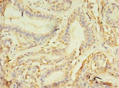 NAIF1 Antibody - Immunohistochemistry of paraffin-embedded human breast cancer using NAIF1 Antibody at dilution of 1:100