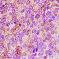 NAK / TBK1 Antibody - Immunohistochemical analysis of TBK1 staining in human breast cancer formalin fixed paraffin embedded tissue section. The section was pre-treated using heat mediated antigen retrieval with sodium citrate buffer (pH 6.0). The section was then incubated with the antibody at room temperature and detected using an HRP conjugated compact polymer system. DAB was used as the chromogen. The section was then counterstained with haematoxylin and mounted with DPX.